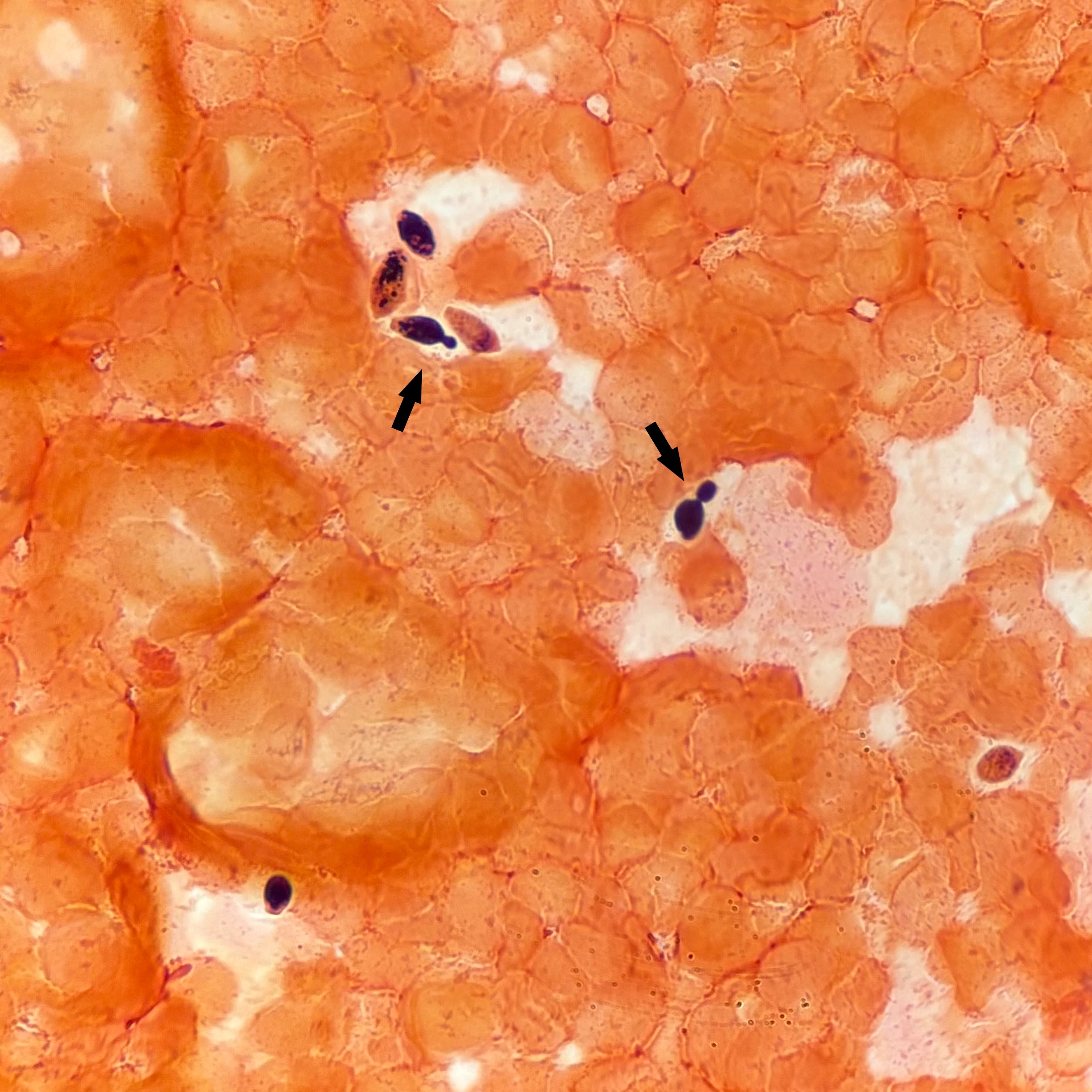 Pathology Outlines - Candida species