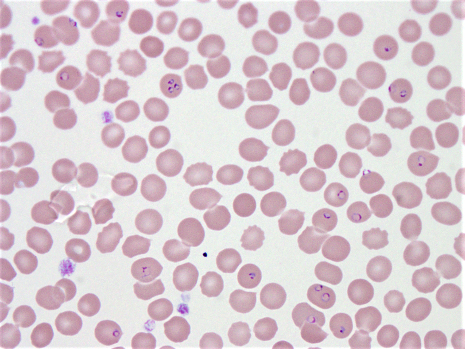 Plasmodium falciparum (blood smear)