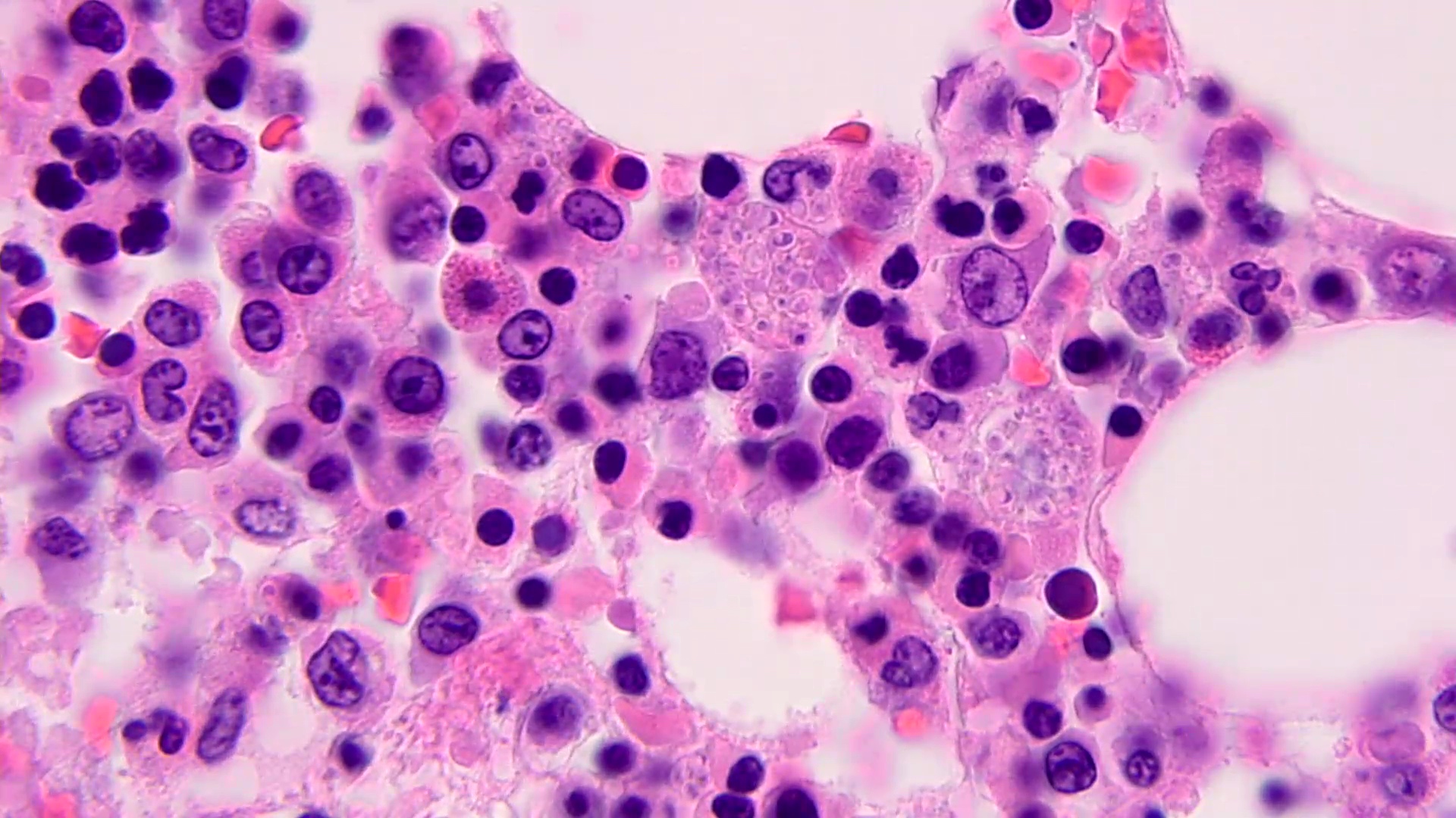 Bone marrow with clustered yeasts
