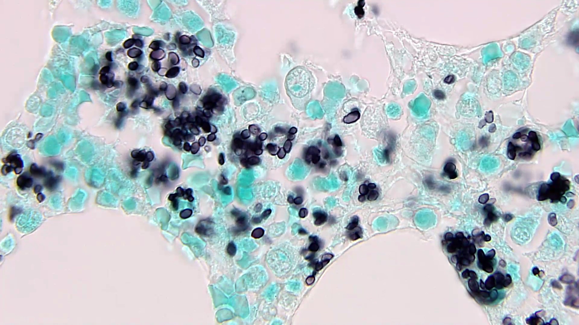 GMS showing clustered yeasts