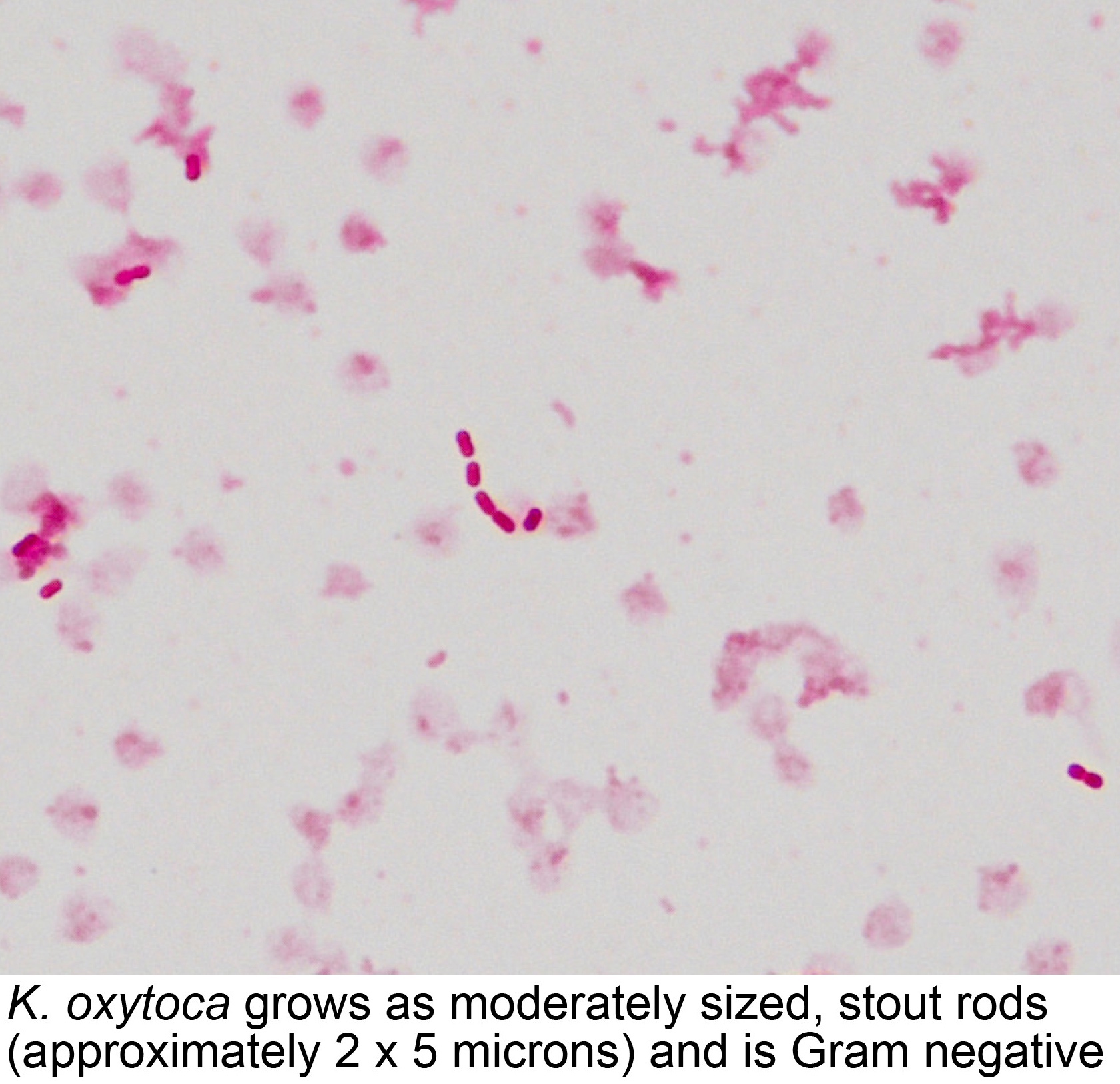 Pathology Outlines Klebsiella Oxytoca