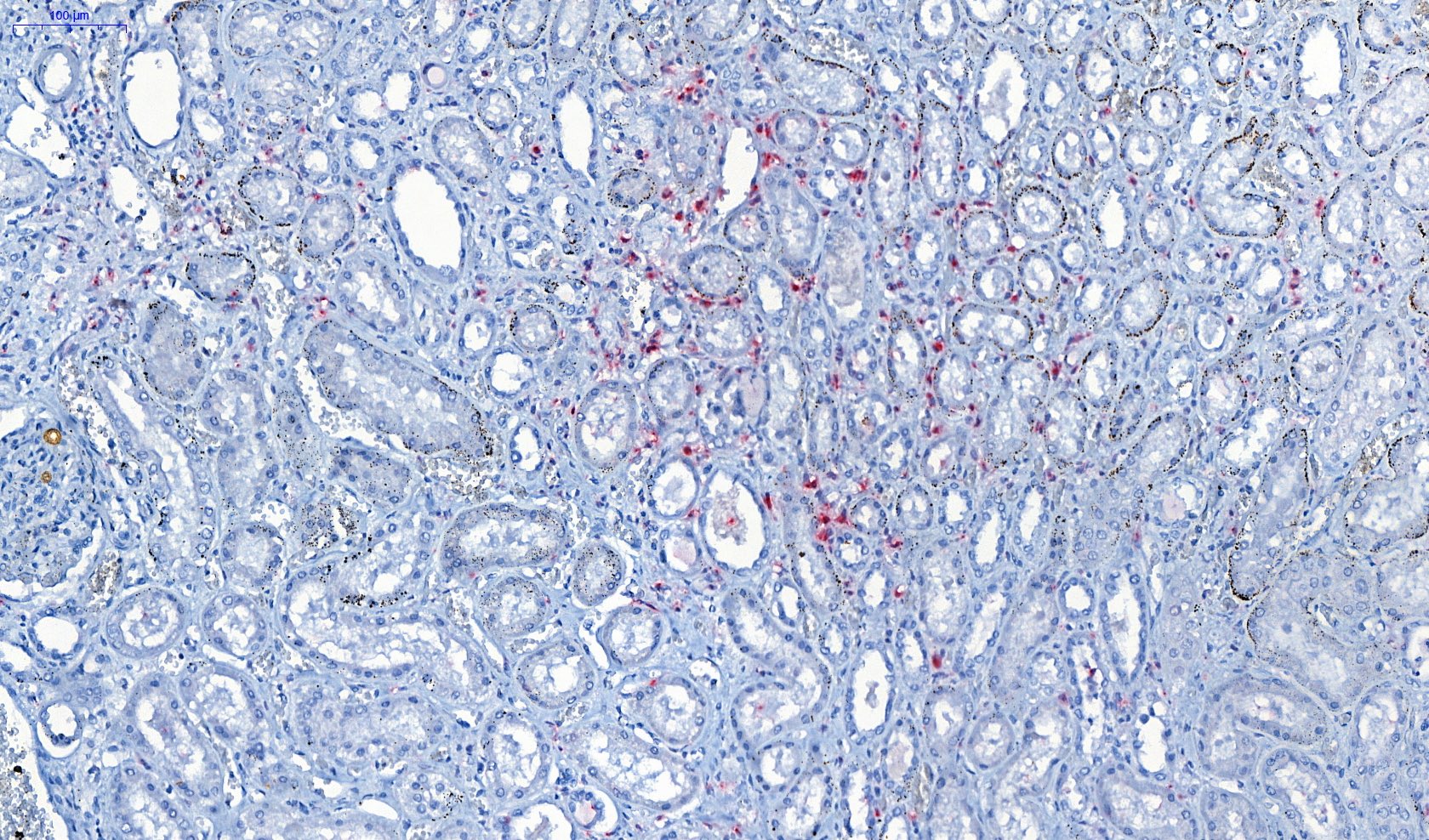 Renal lesion in leptospirosis (interstitial nephritis) - IHC
