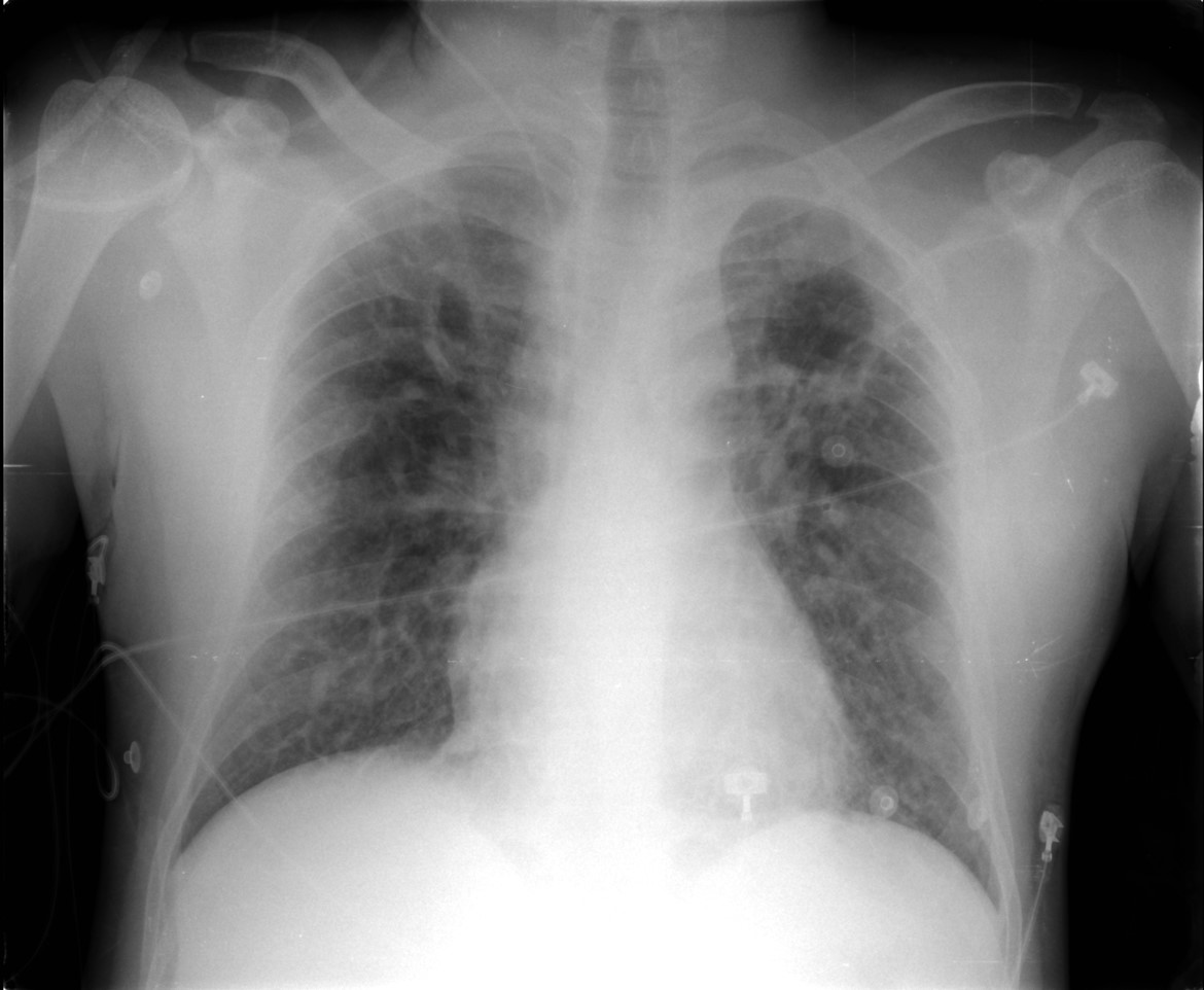 Bilateral and diffuse alveolar interstitial pattern