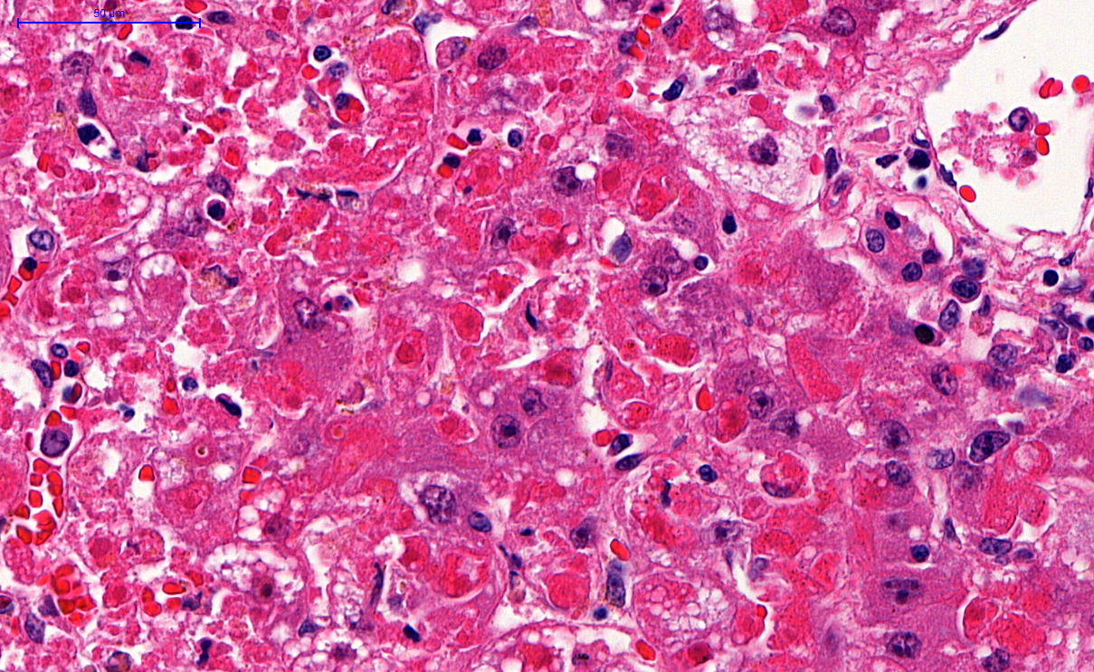 Centrilobular area in yellow fever hepatitis