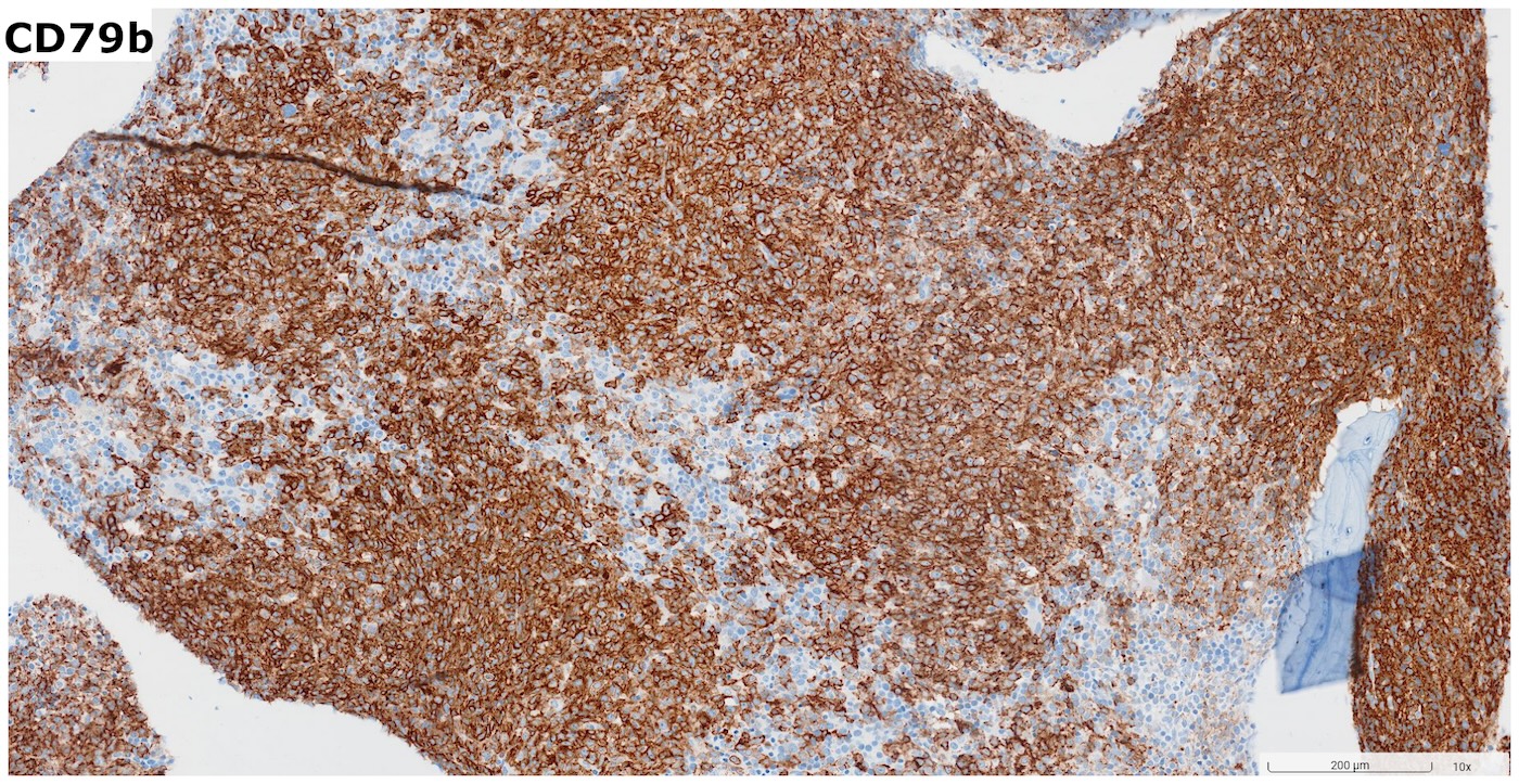 Pathology Outlines - CD79b