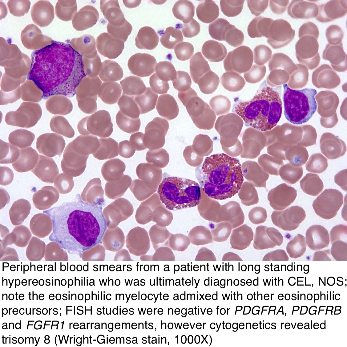 Pathology Outlines Chronic Eosinophilic Leukemia