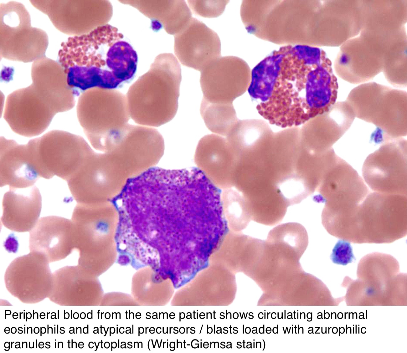 Pathology Outlines Chronic Eosinophilic Leukemia