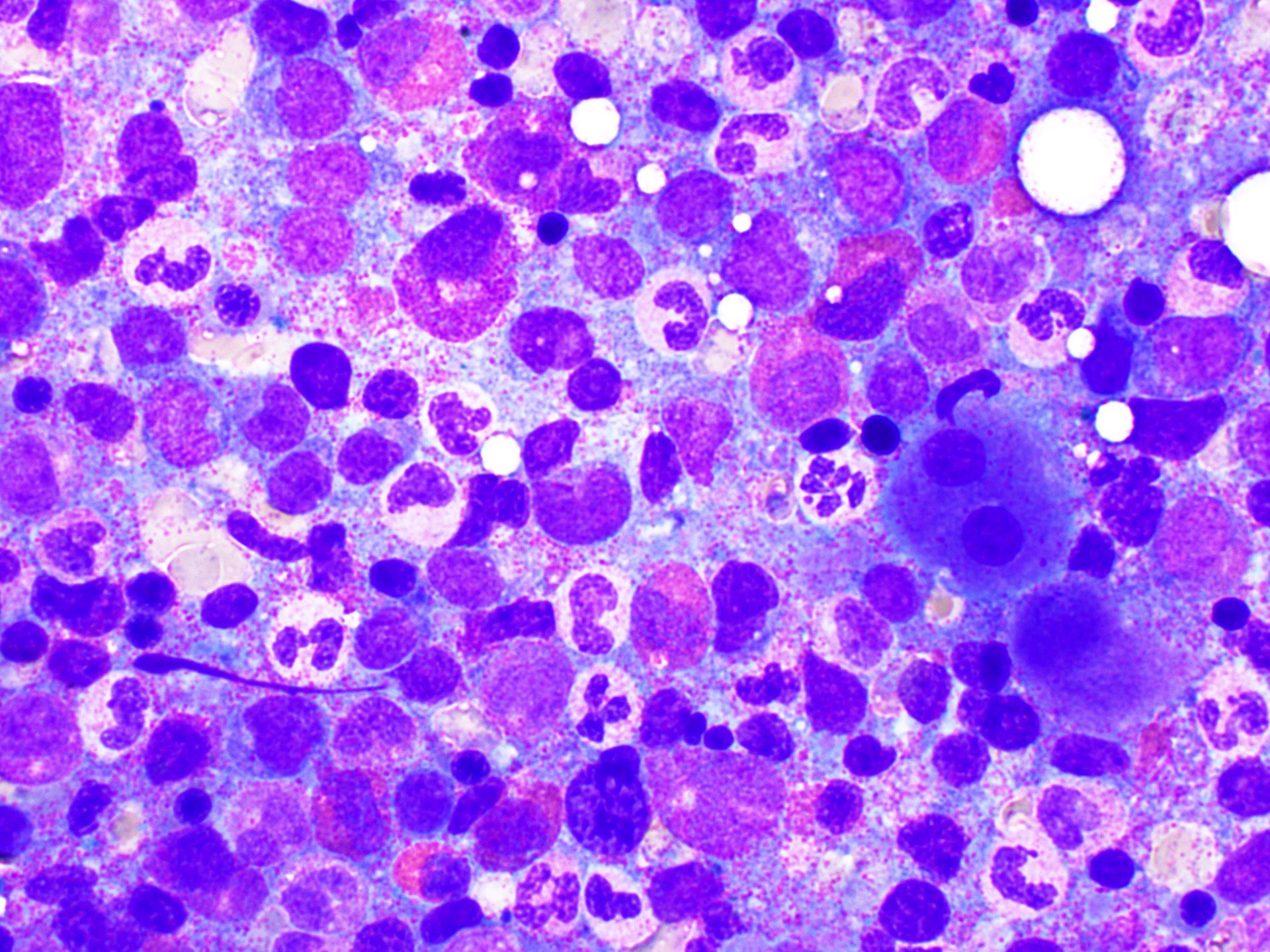 Dysplastic megakaryocytes and neutrophils