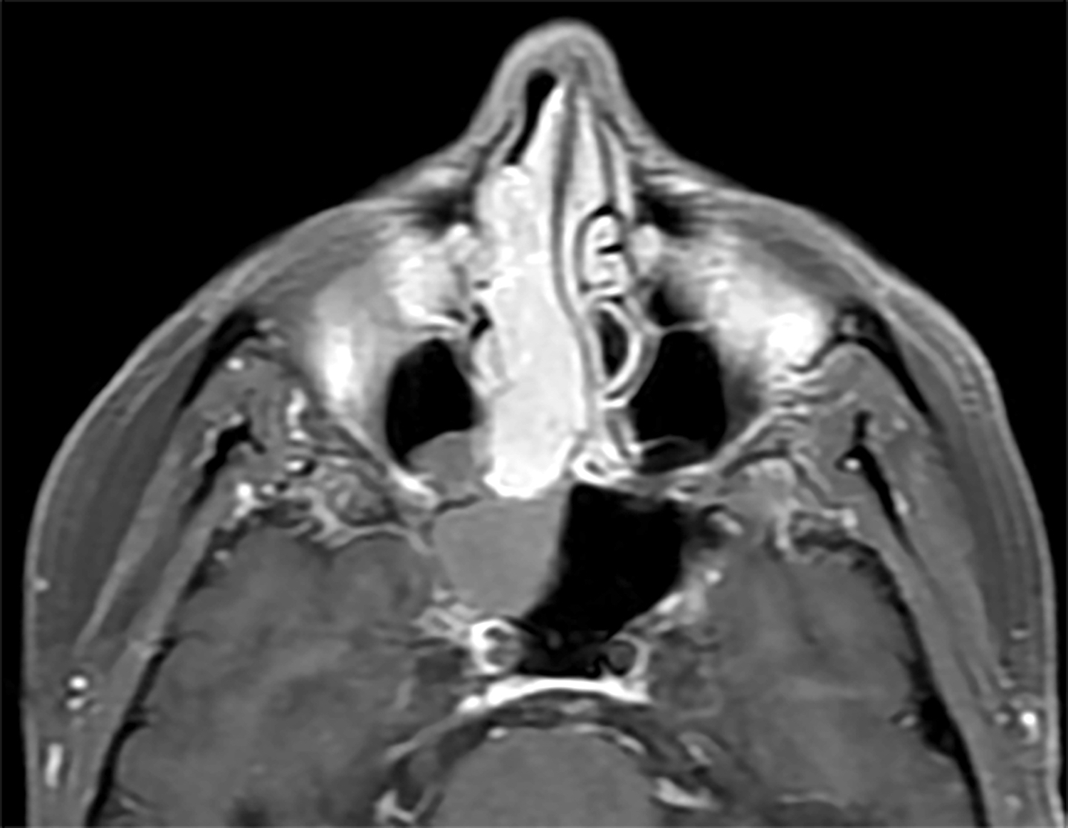 Right nasal mass (MRI axial)