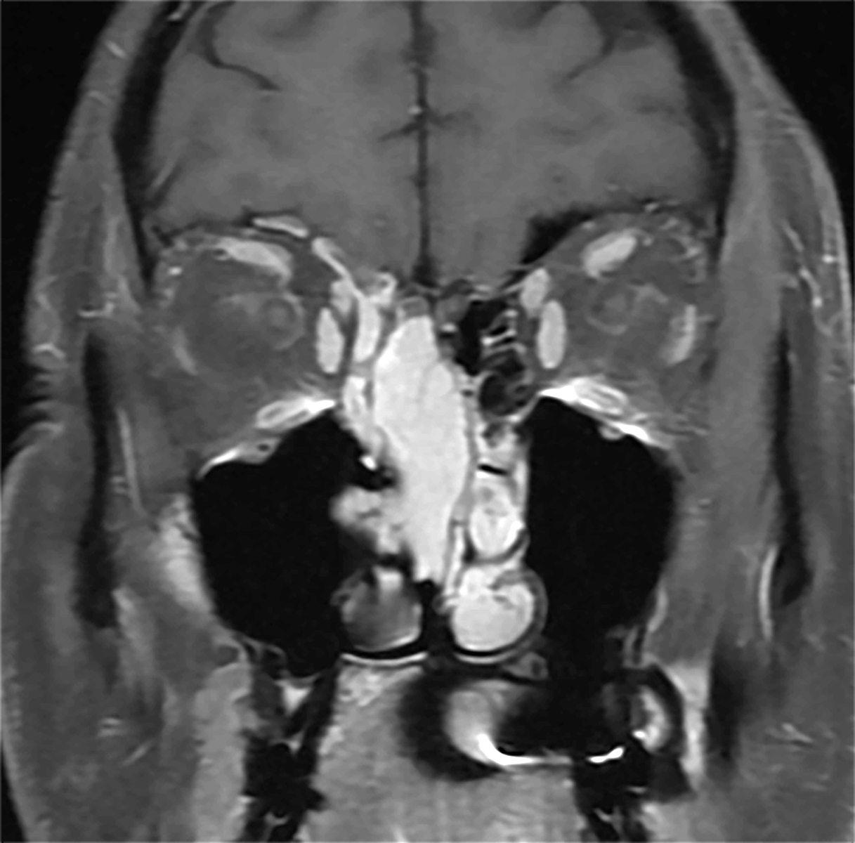 Right nasal mass (MRI coronal)