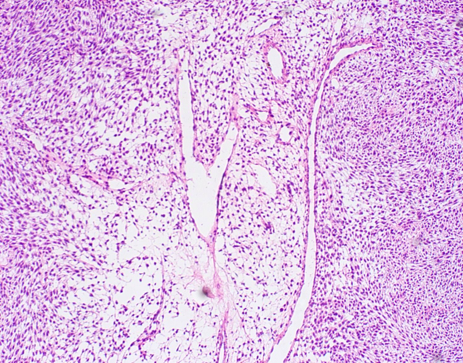 Perivascular proliferation and staghorn vessels