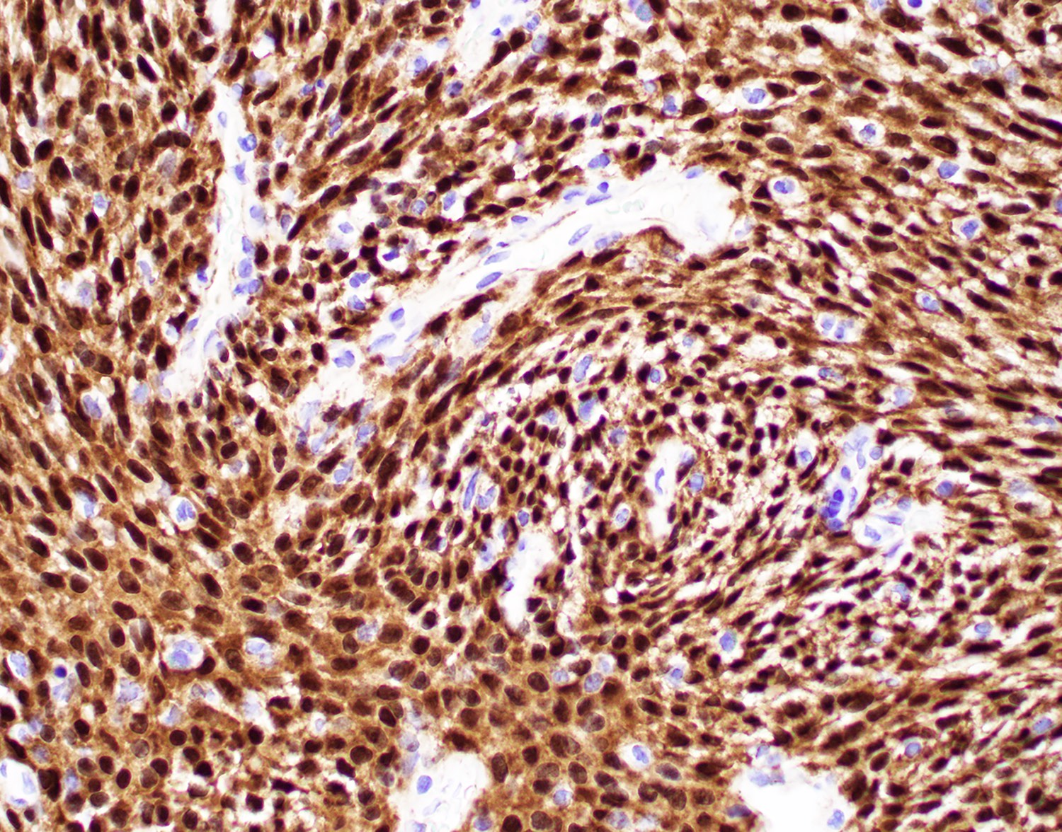 Beta catenin nuclear staining