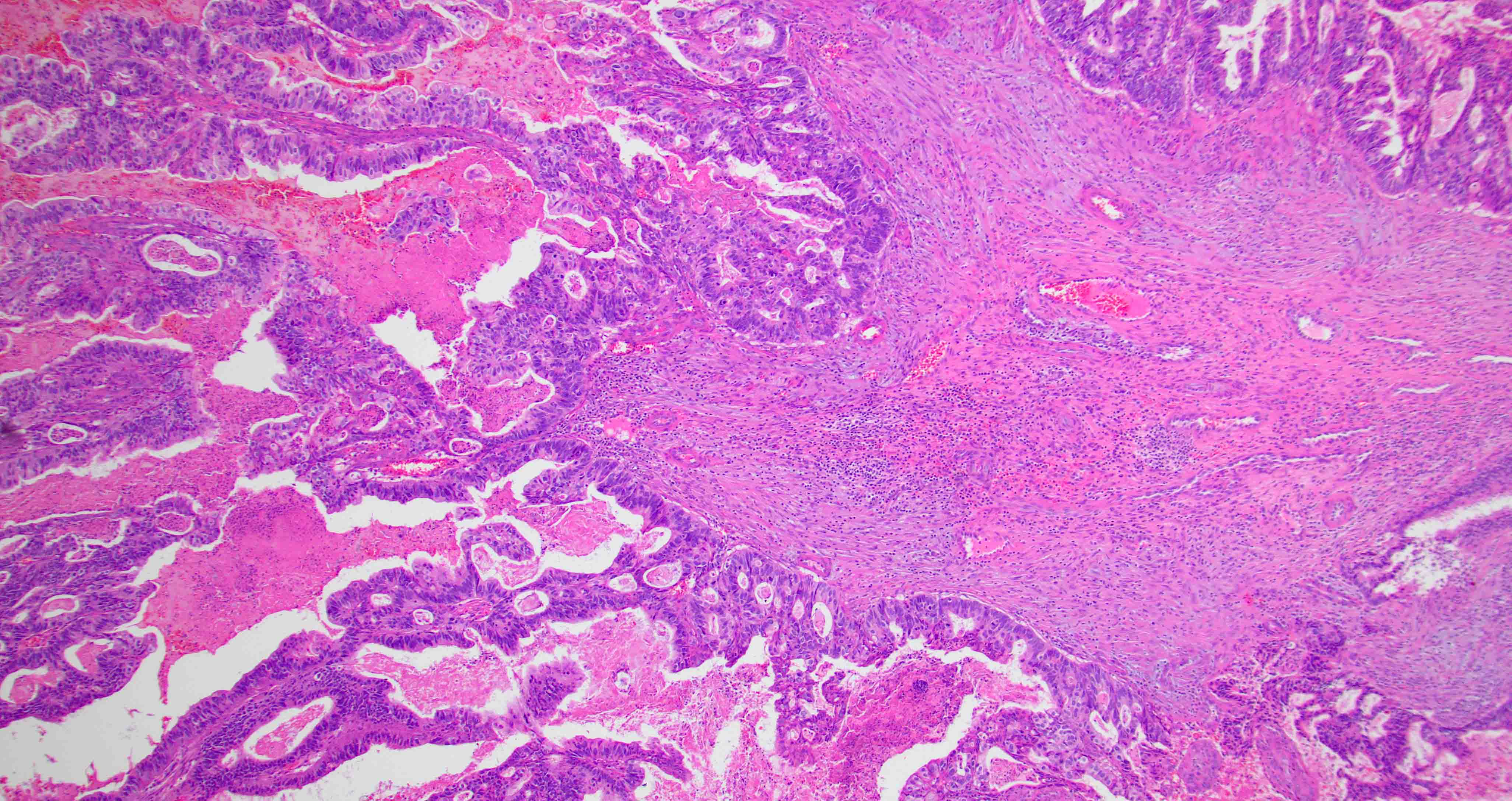 Adenocarcinoma with various architectures