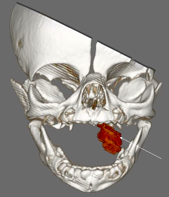 3 dimensional reconstructed oral lesion