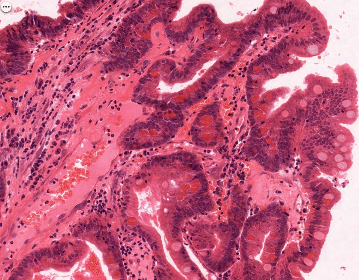 Papillary pattern with goblet cells