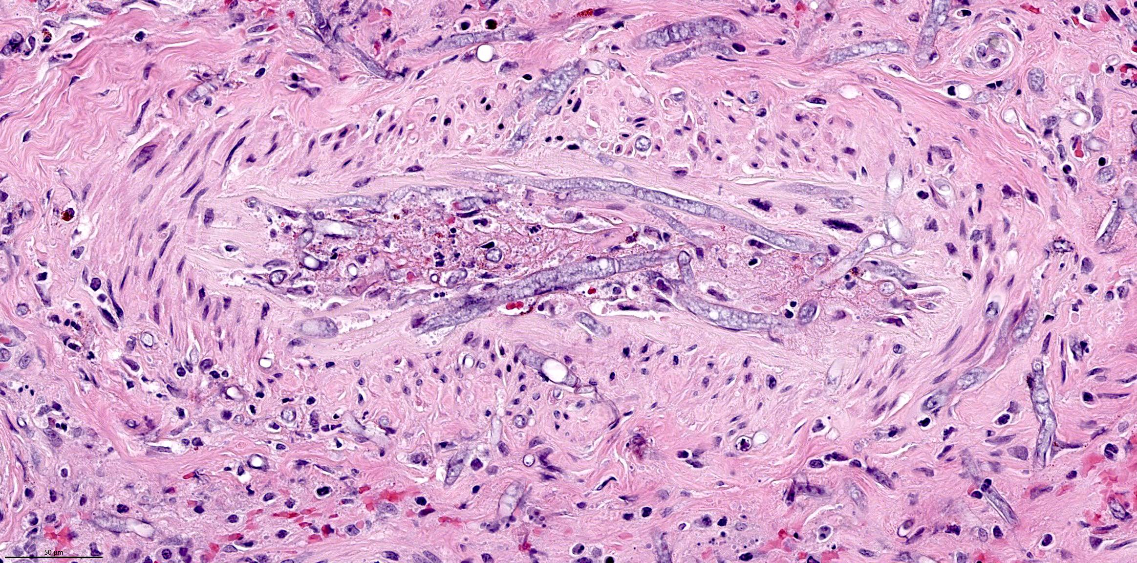 Pathology Outlines - Invasive fungal rhinosinusitis