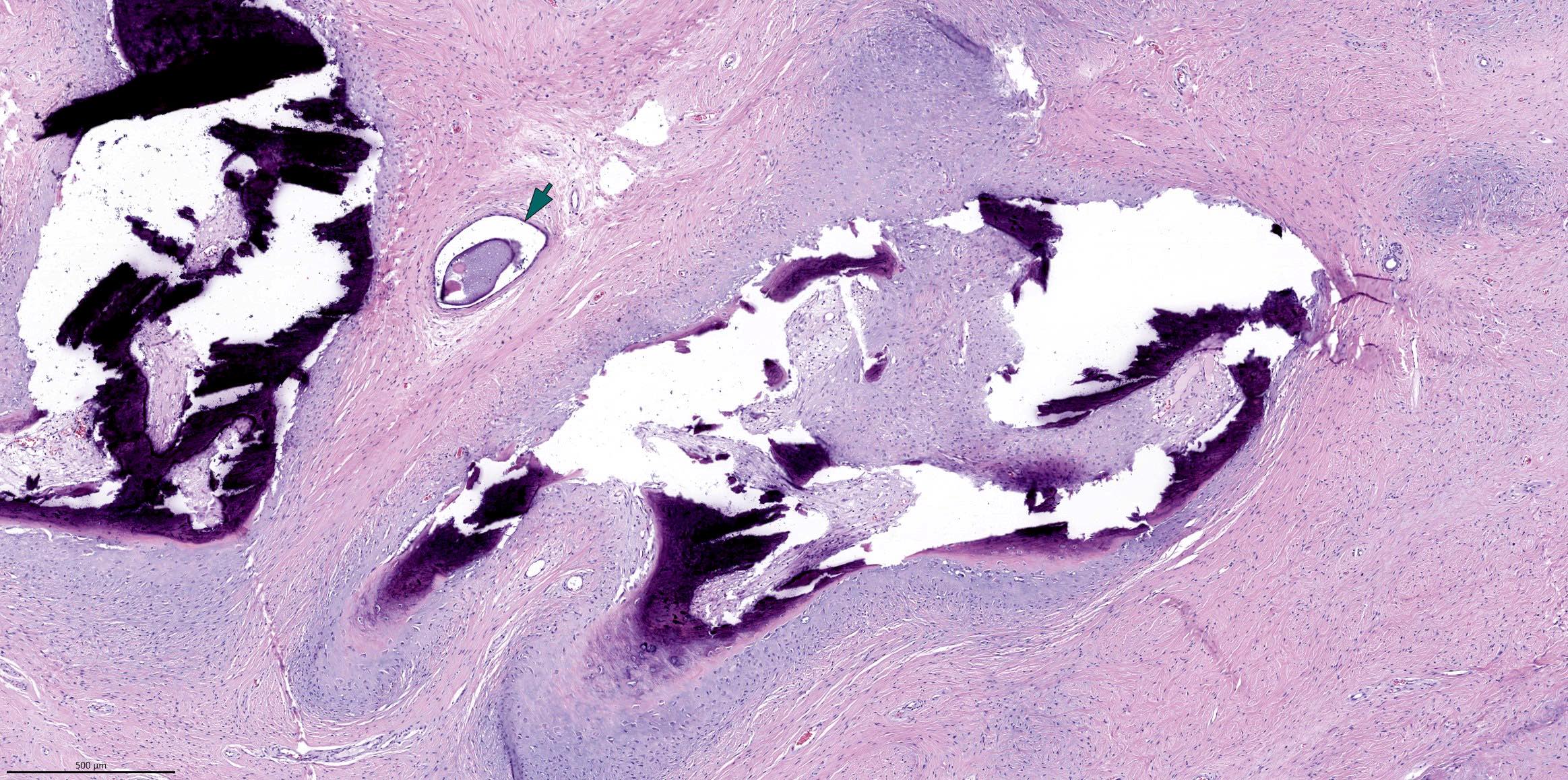 Glands and chondromyxoid stroma