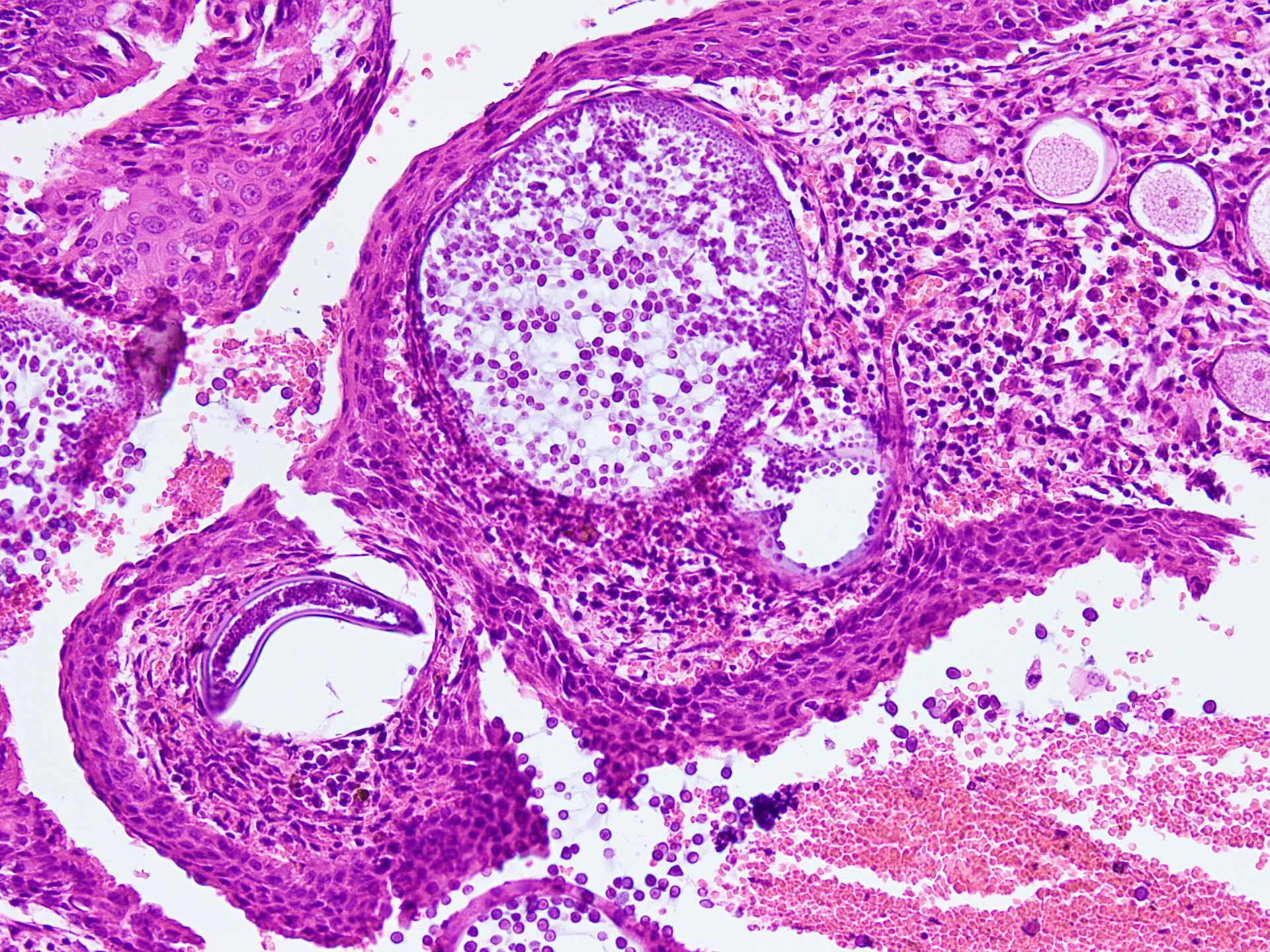 Pathology Outlines - Rhinosporidiosis