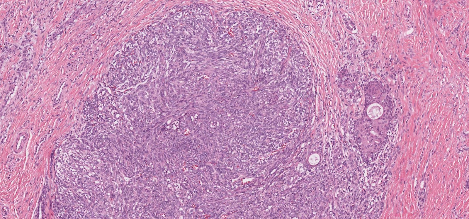Salivary gland anlage tumor
