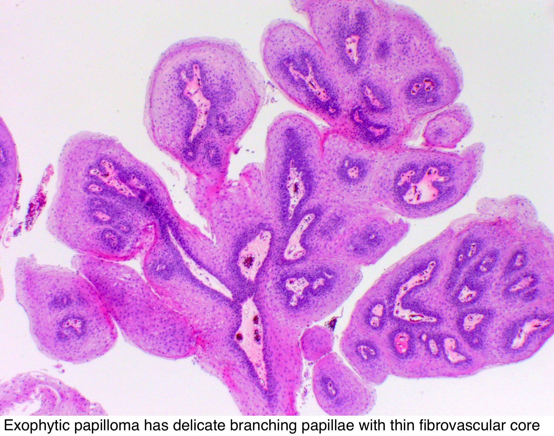 Exophytic papillomas