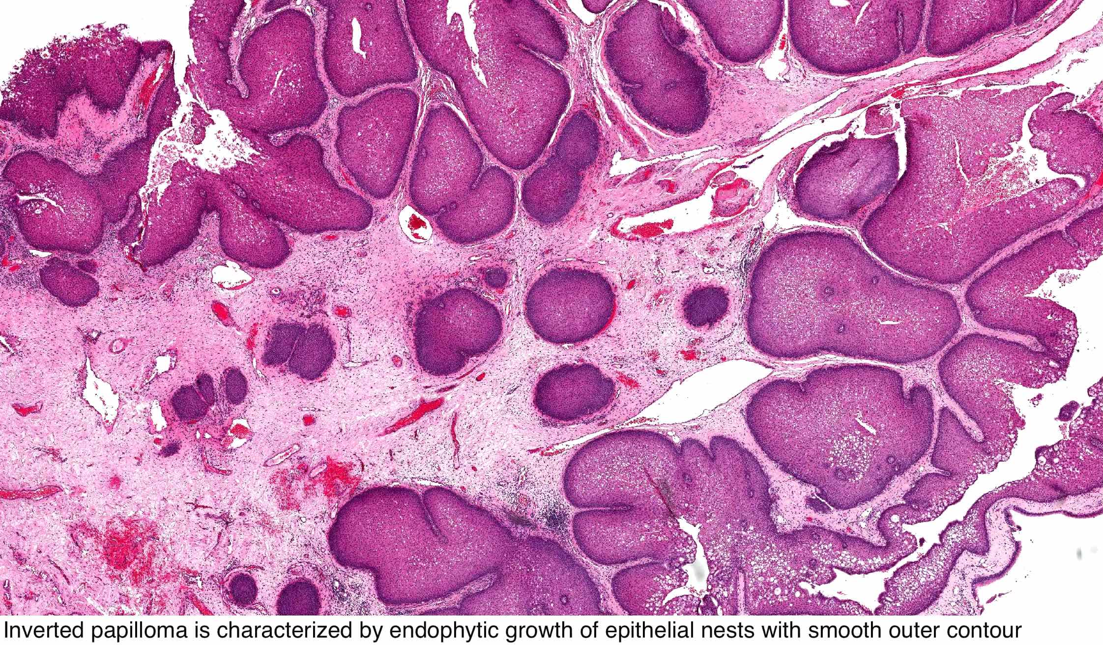 Papilloma sinus cavity.