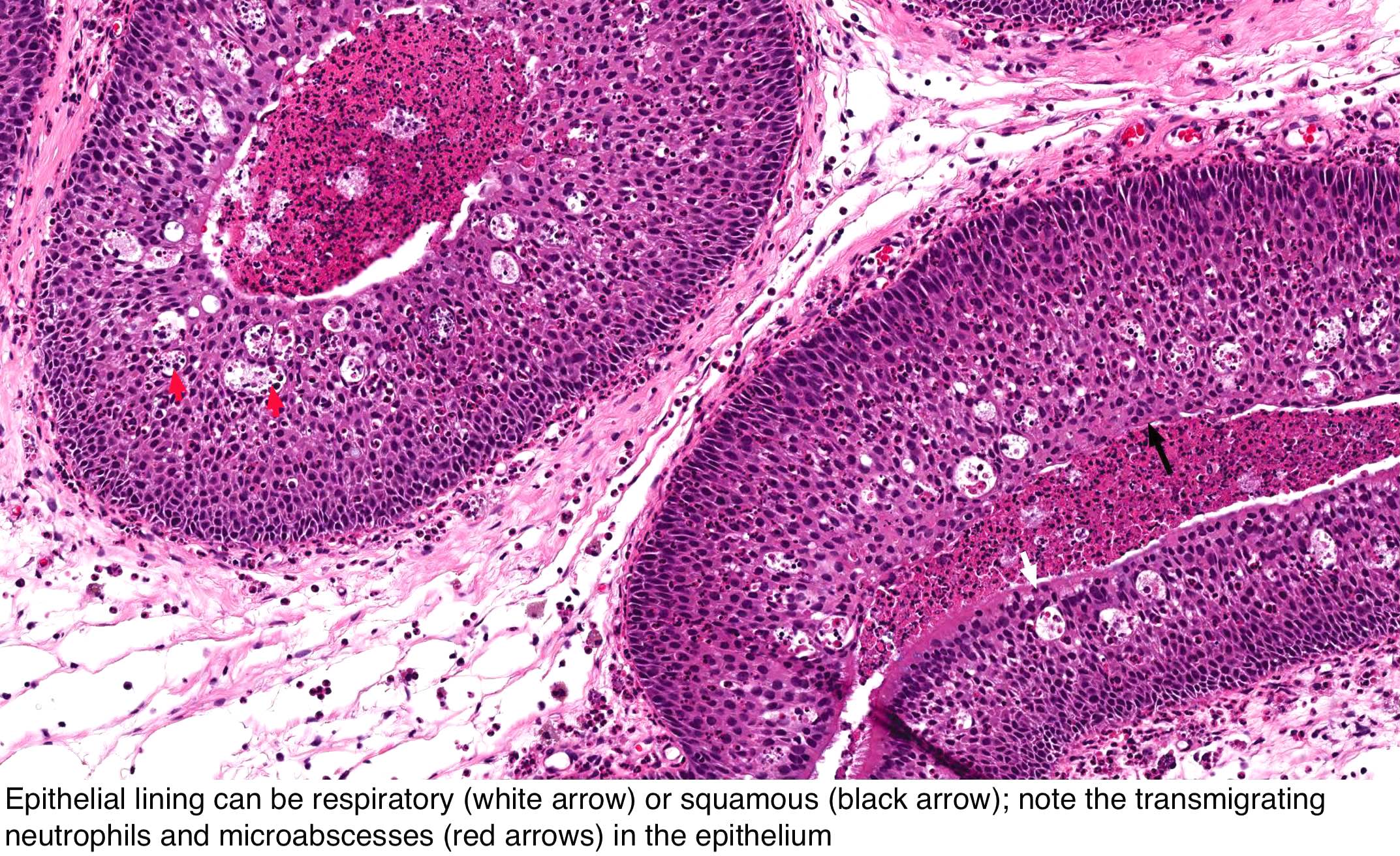 Sinonasal papilloma pathology outlines