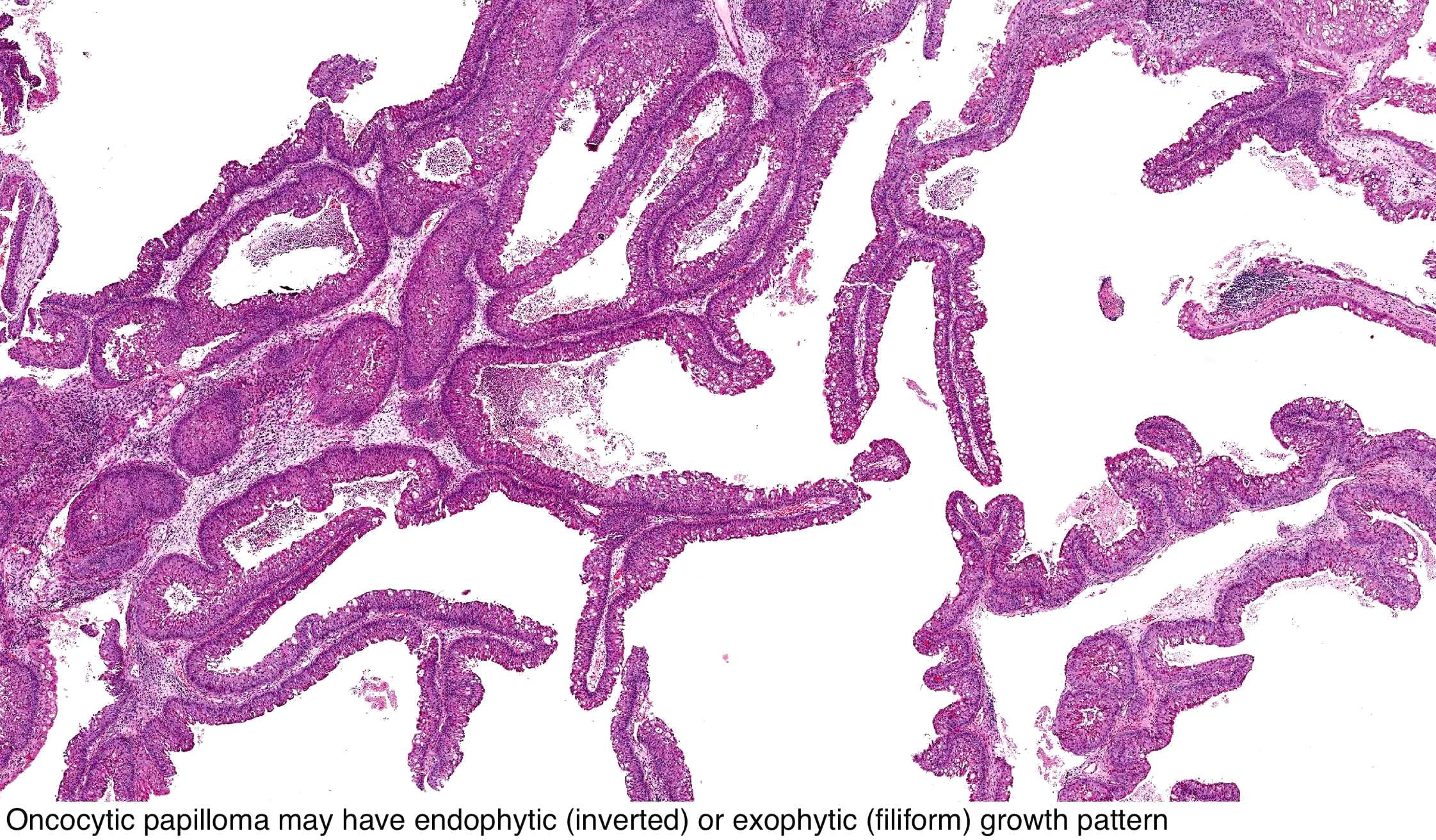 oncocytic papilloma sinus oxiuros y piscina
