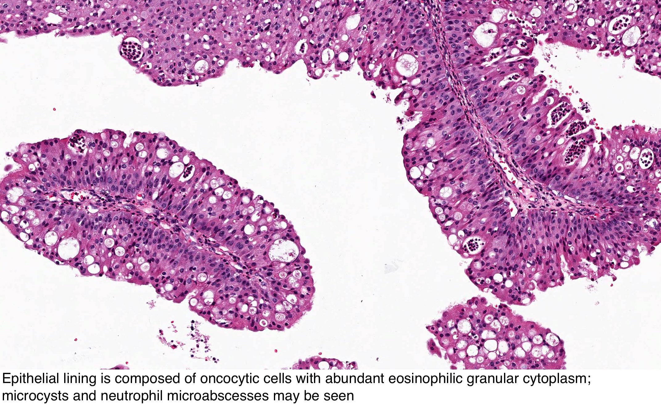 Oncocytic papilloma sinus Papillary thyroid carcinoma oncocytic, biologie tiroidian