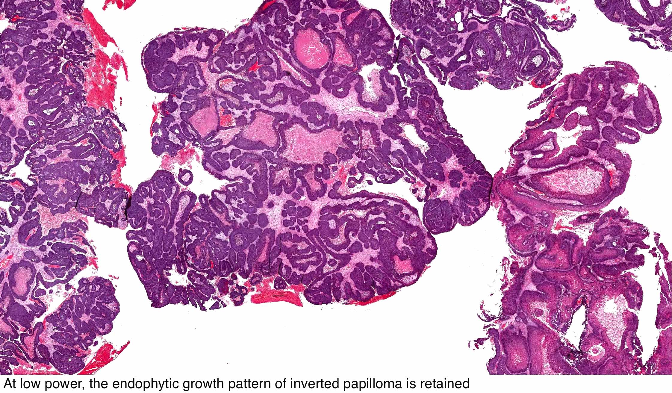 nasal papilloma pathology outlines