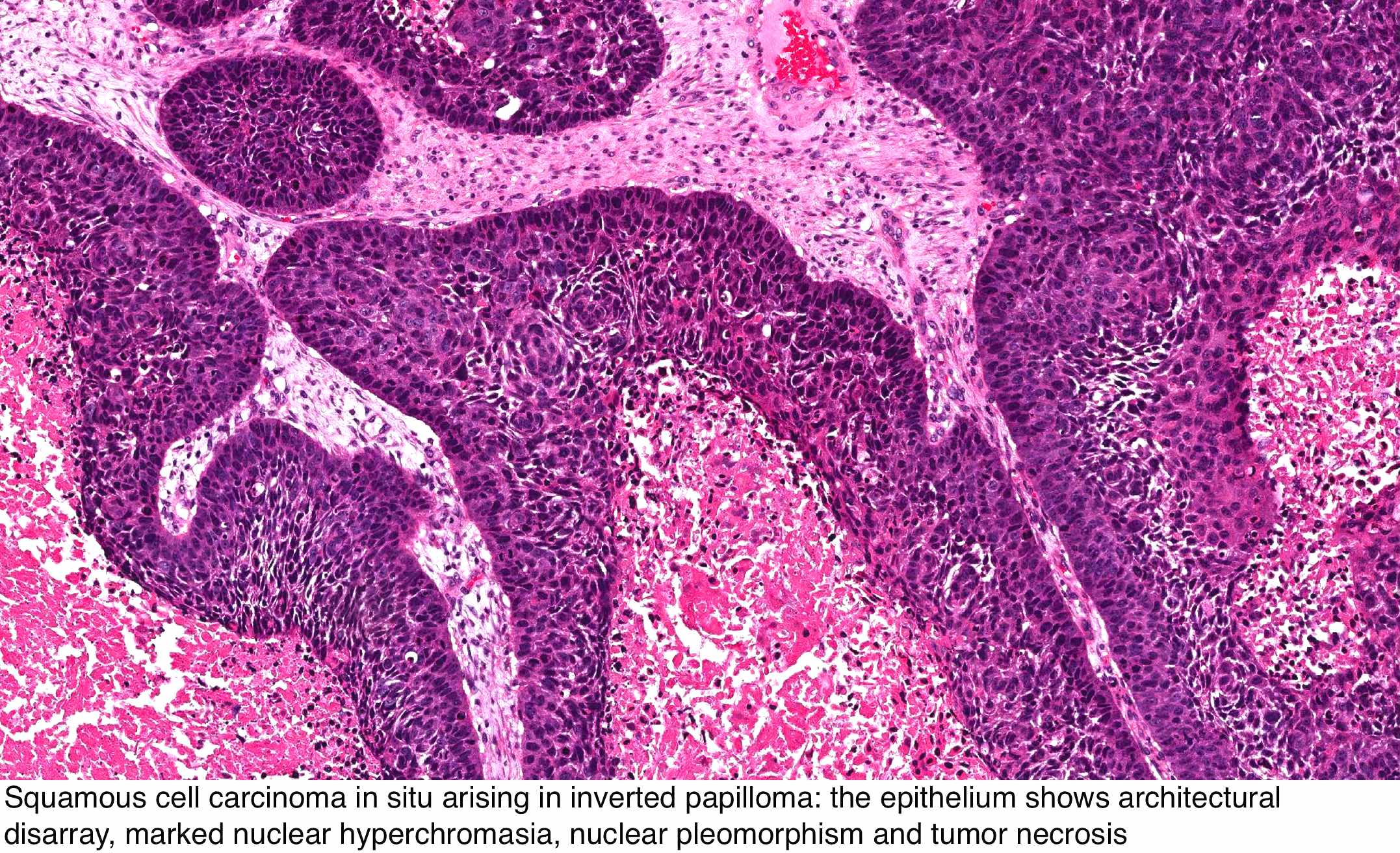 nasal papilloma pathology