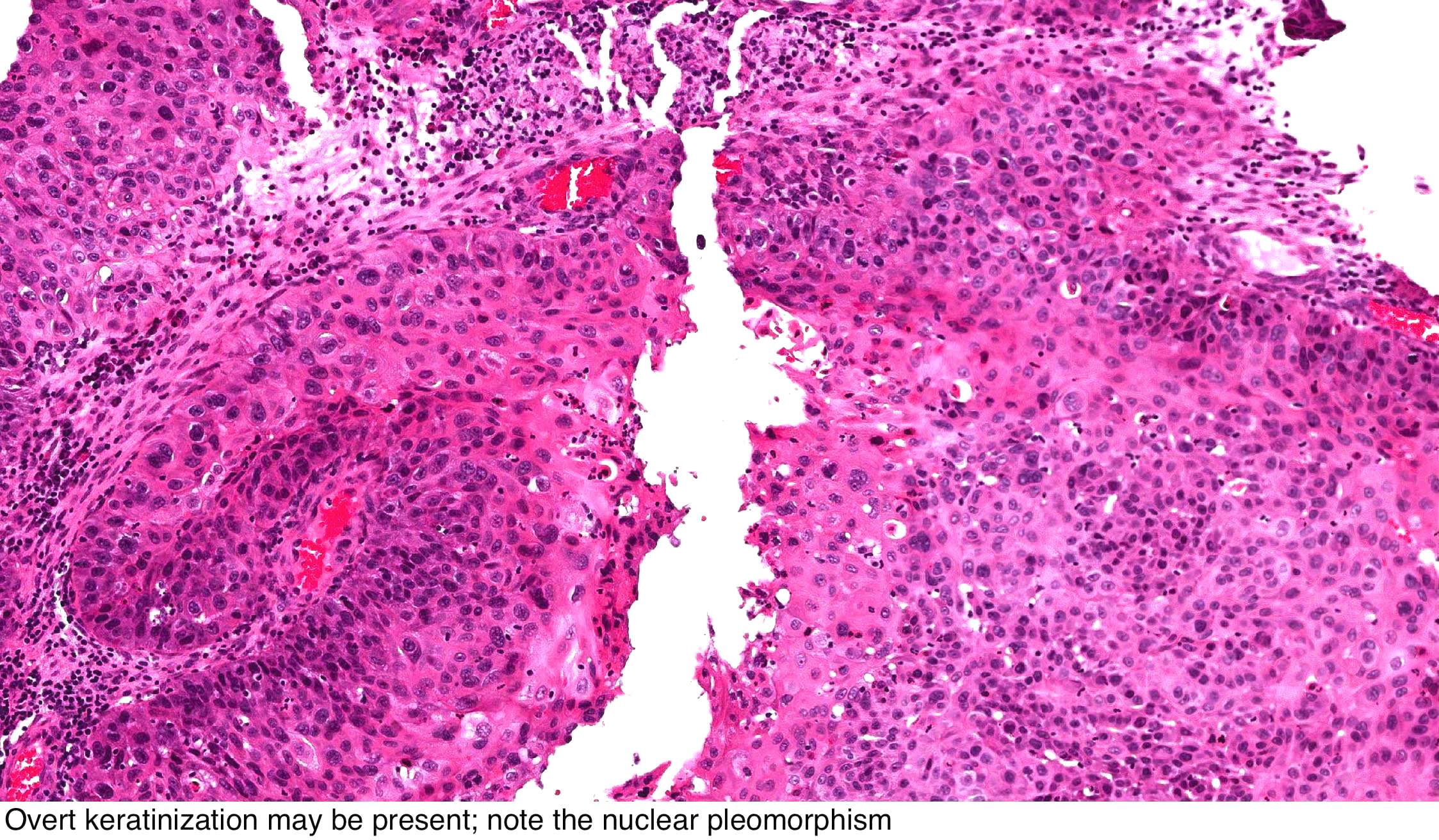 Papiloma nasosinusal histologia - Canceres Uroteliales tratamentul simptomelor viermilor copiilor
