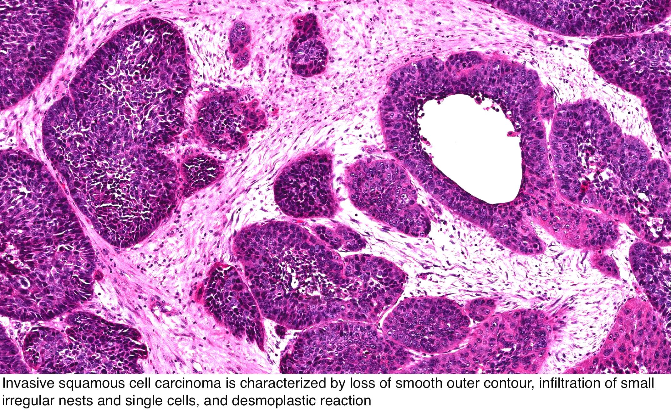 inverted papilloma oncocytic type