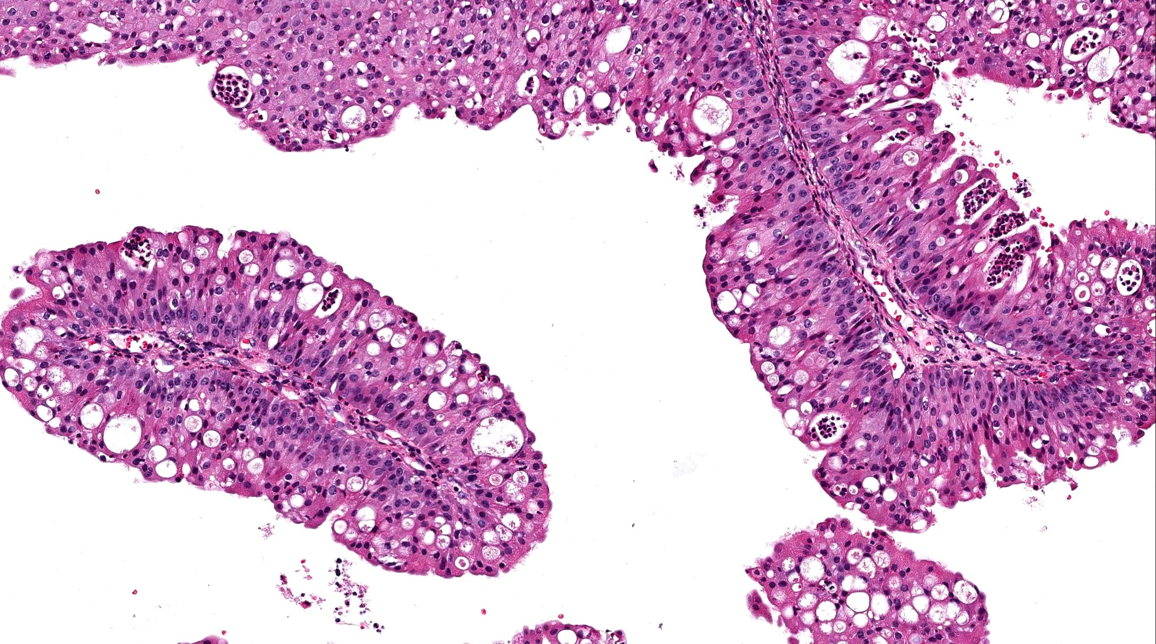 Nasal inverted papilloma histology. Inverted papilloma nasal pathology. Schistosomiasis haematobium