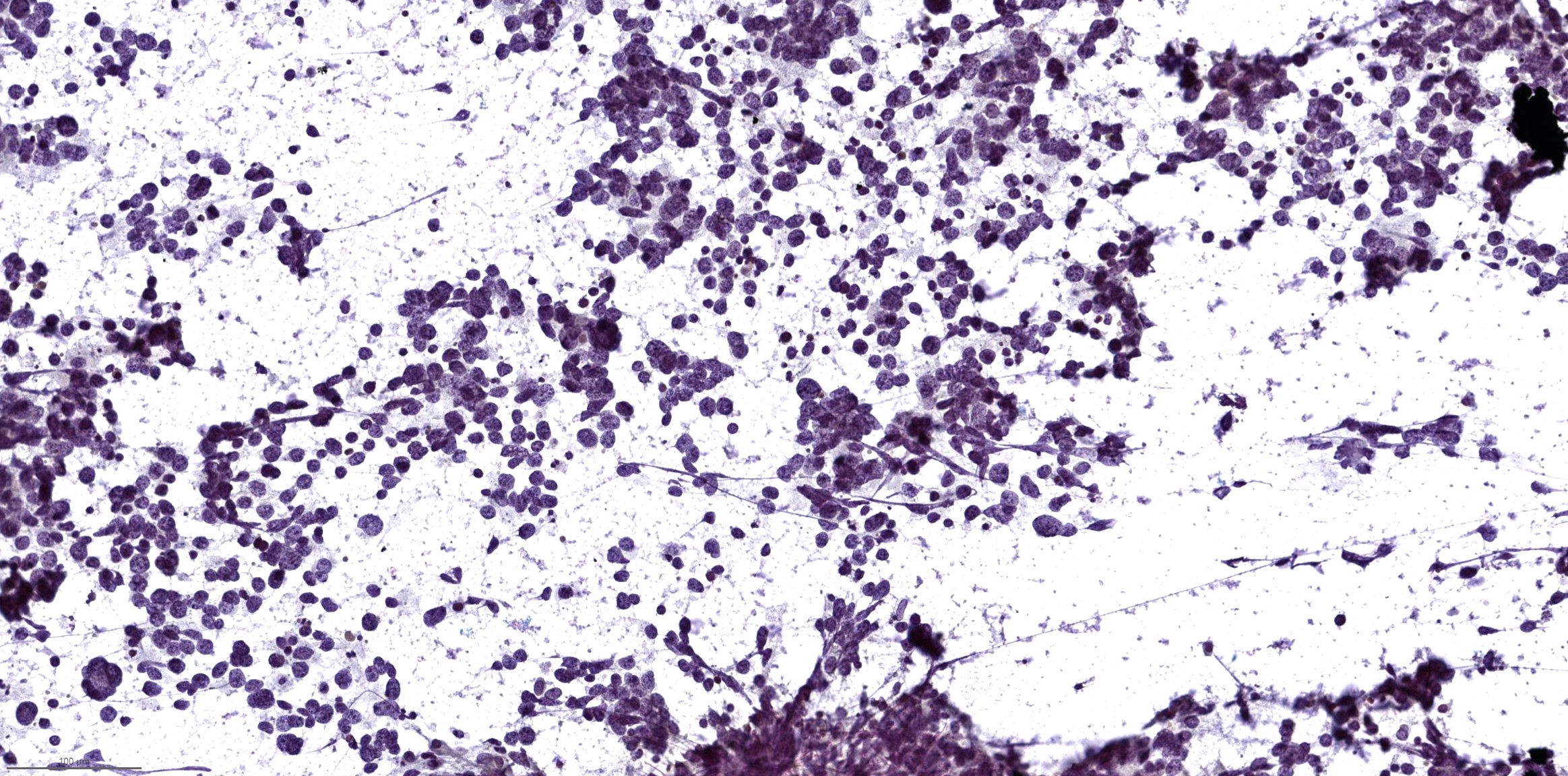 Small cell carcinoma