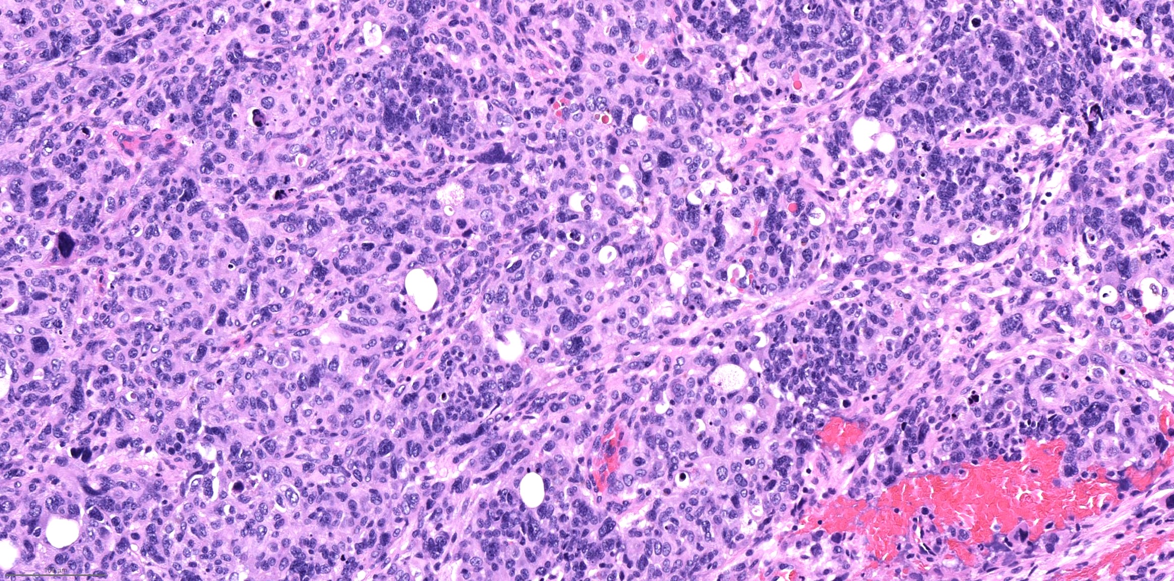 Large tumor cells