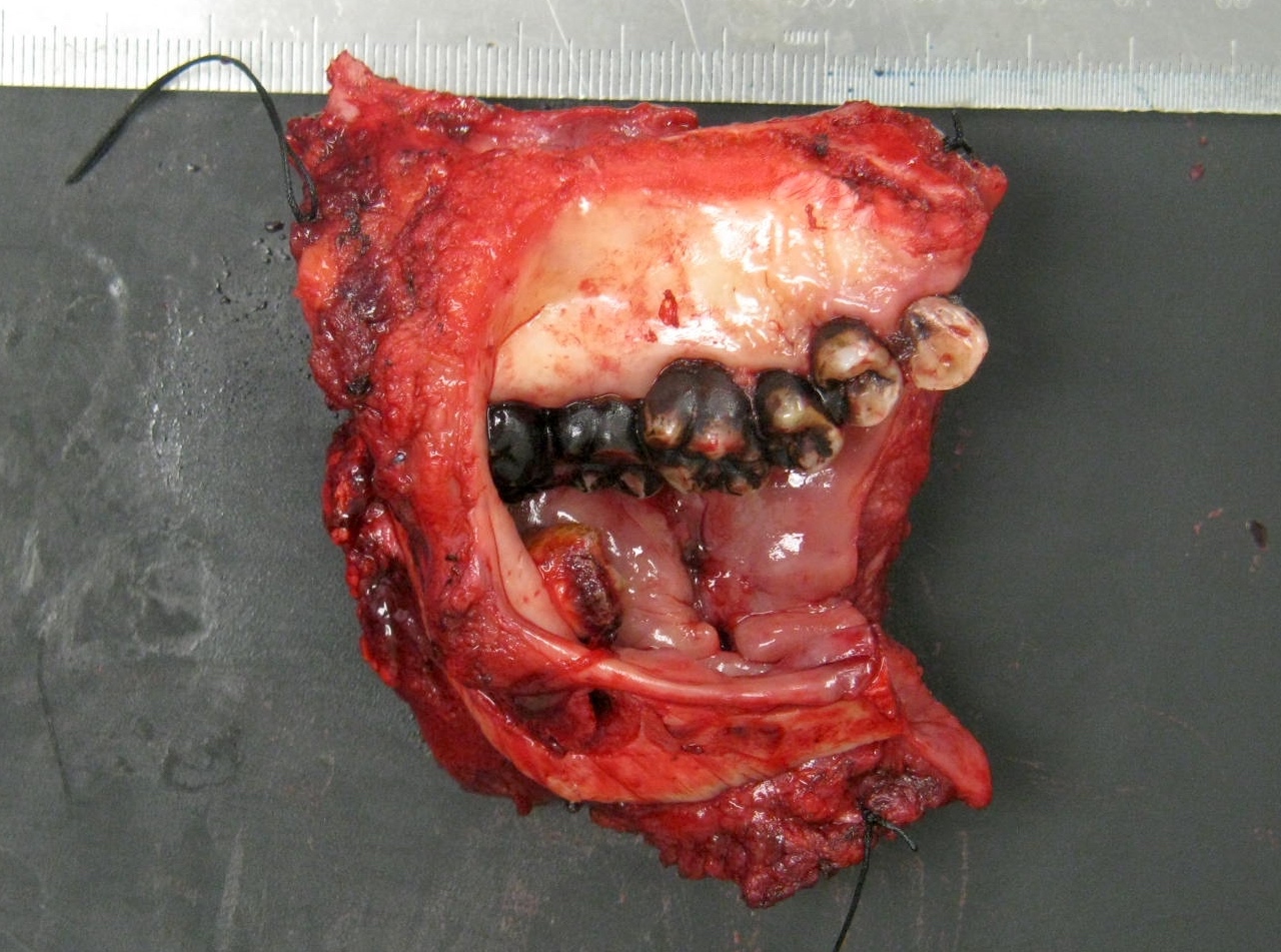 Ulceroproliferative mucosal lesion