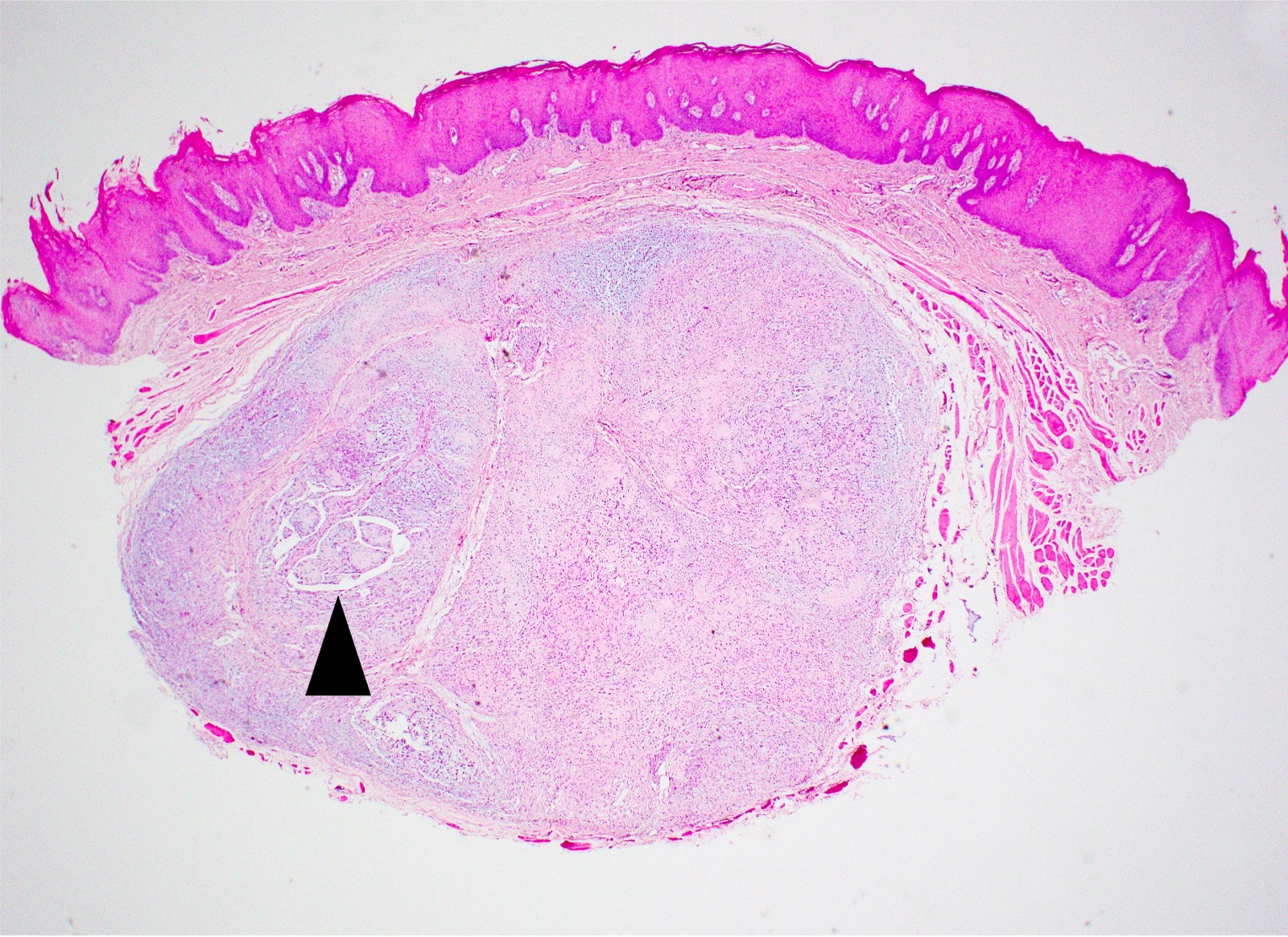 Focal papillary growth pattern