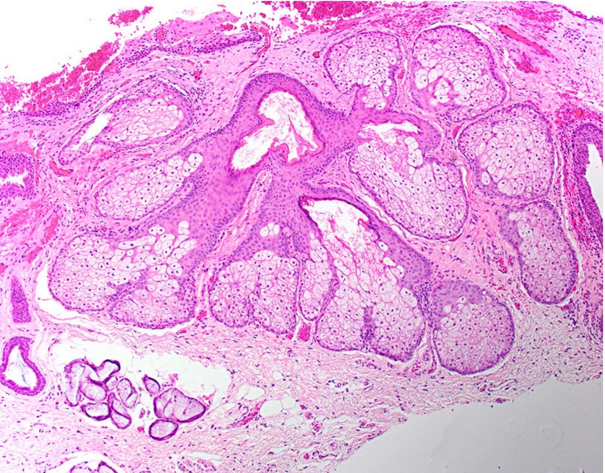 Fordyce Spots Oral Mucosa Fordyce Spots Oral Mucosa
