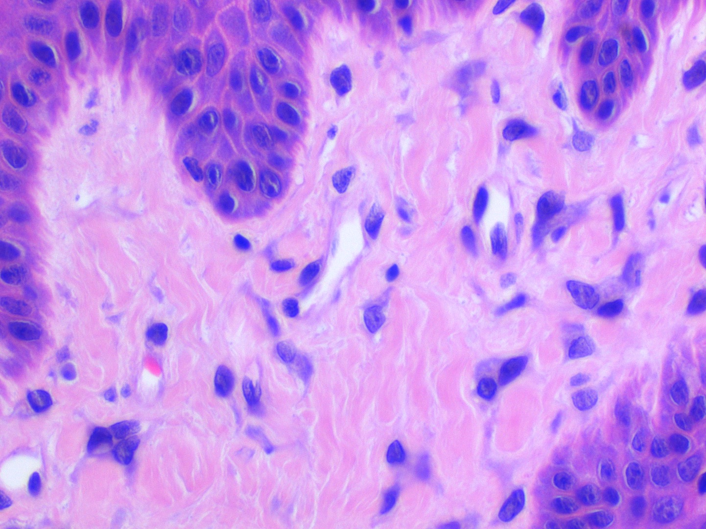 Multinucleated fibroblasts