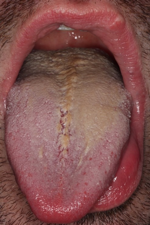 Image Gallery Black hairy tongue in a patient receiving enteral feeding   Wang  2019  British Journal of Dermatology  Wiley Online Library