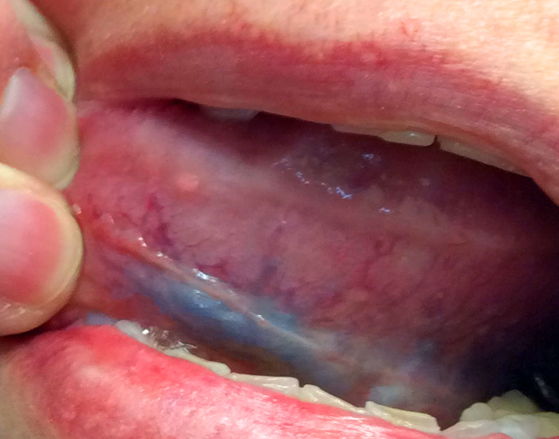 Left ventral tongue leukoplakia