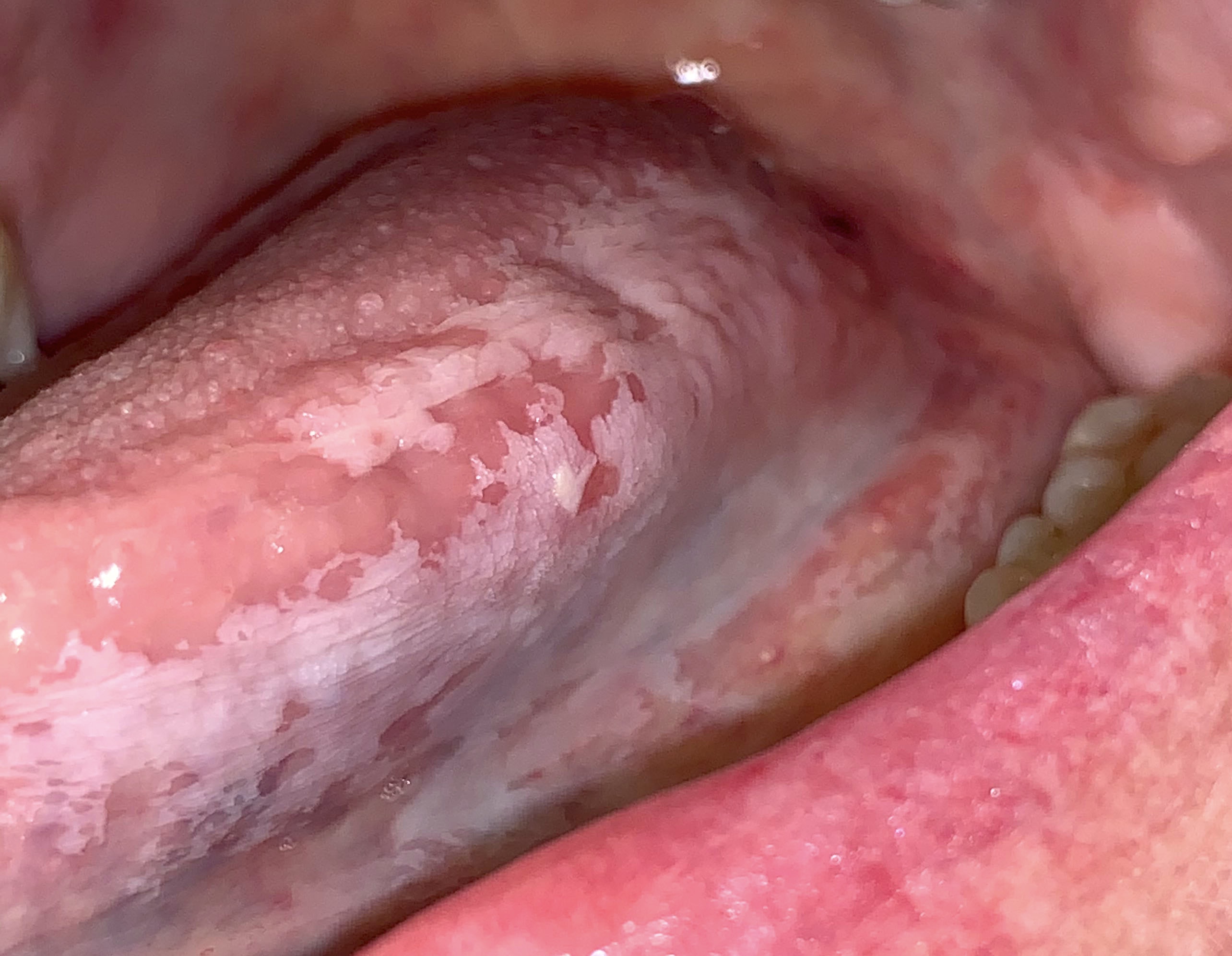Extensive leukoplakia of tongue
