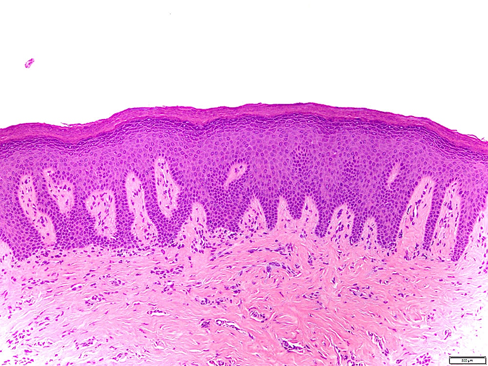 Absence of epithelial atypia