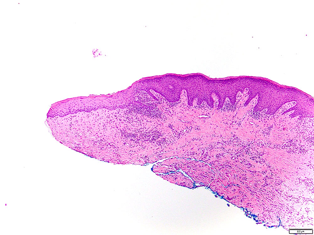 Pathology Outlines Leukoplakia