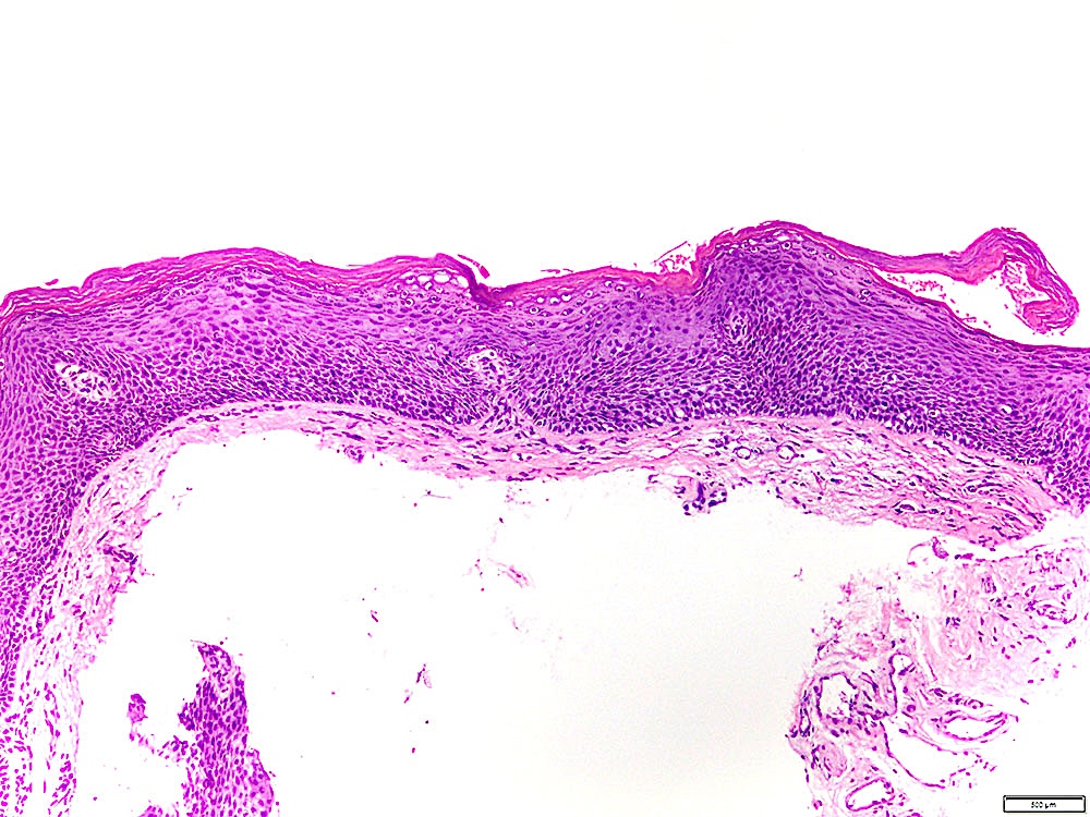 Pathology Outlines Leukoplakia