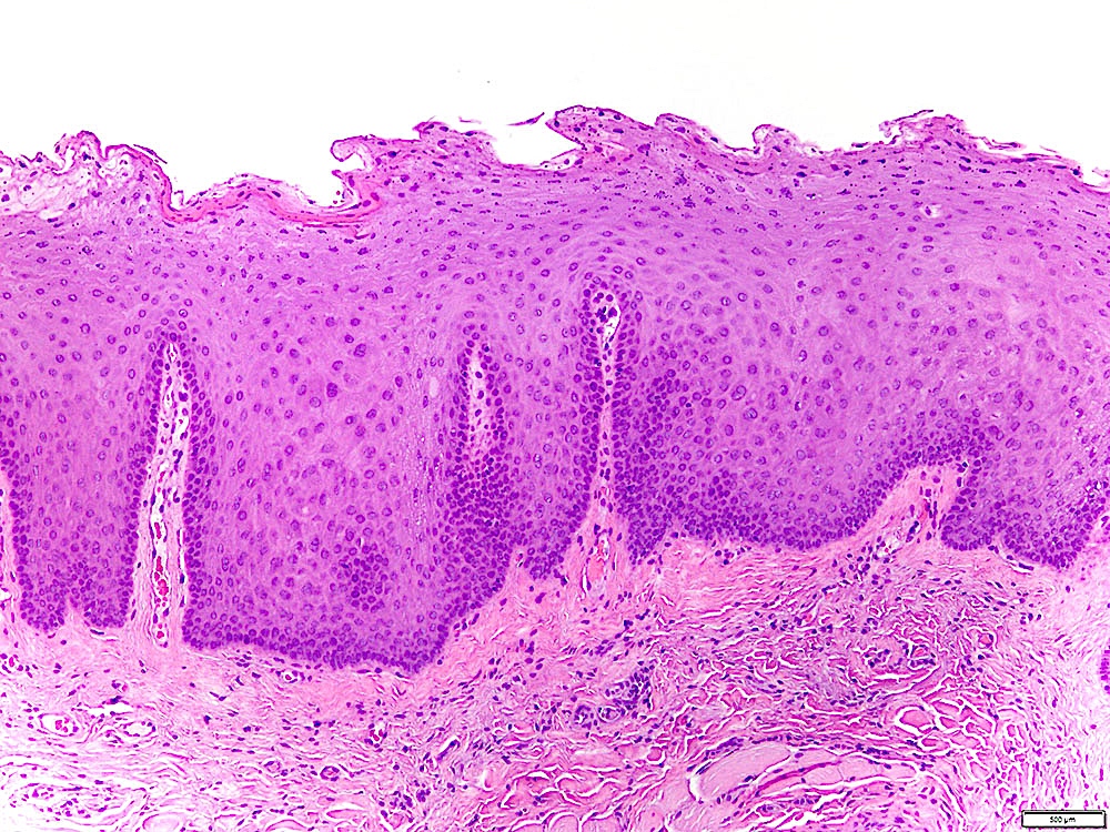 Pathology Outlines Leukoplakia