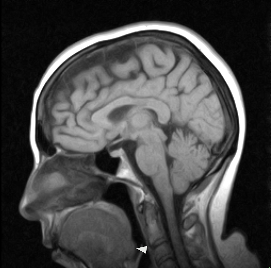 Sagittal T1 weighted MRI