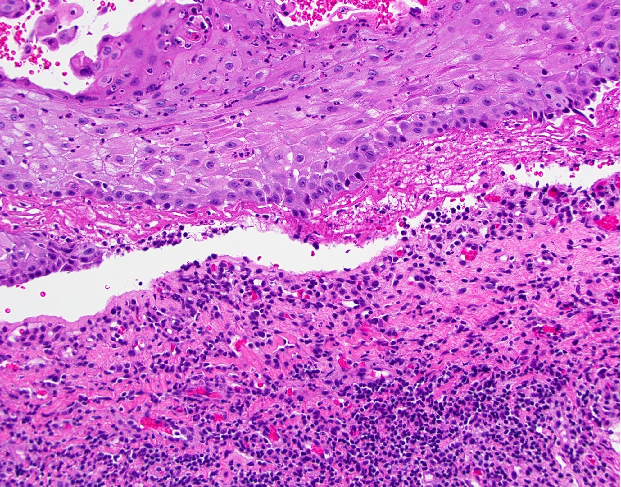 Mucous Membrane Pemphigoid Histology