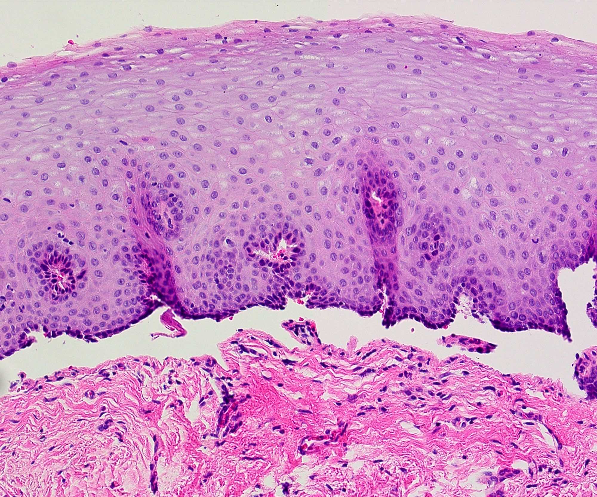 Mucous Membrane Pemphigoid Histology Mucous Membrane Pemphigoid Mmp ...