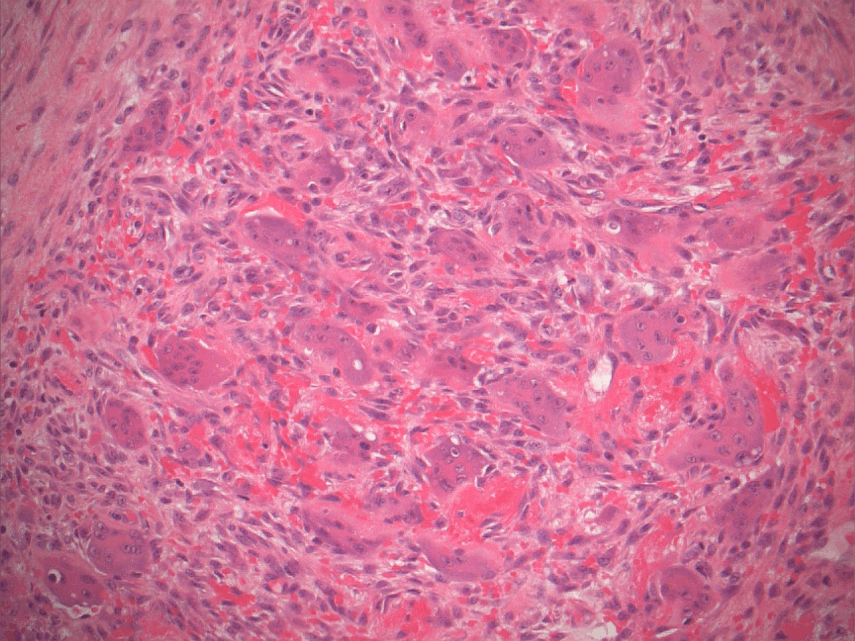 Pathology Outlines Peripheral Giant Cell Granuloma